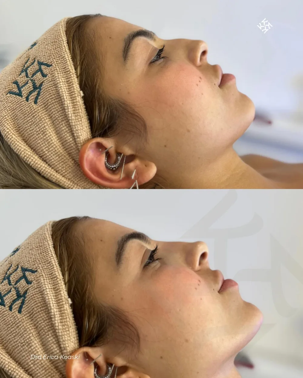 Antes e depois de sessão de acupuntura estética no rosto.