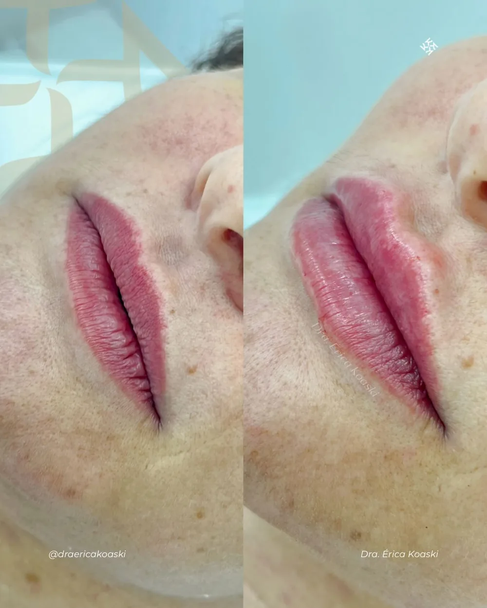 Antes e depois de preenchimento labial feito pela Dra. Érica Koaski.