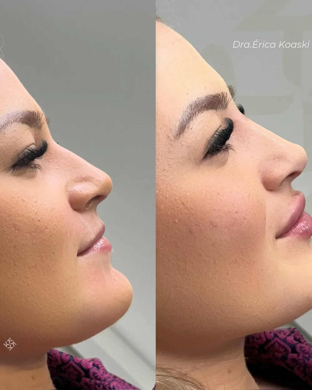 Antes e depois de contorno de perfil visto de lado.
